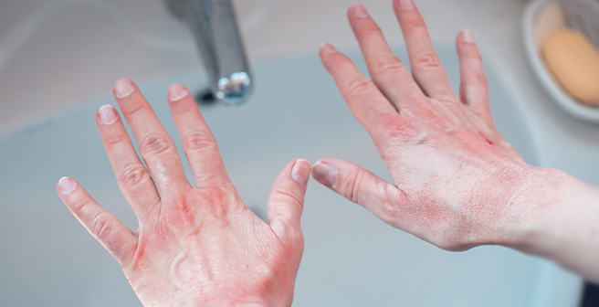 Image of hands with skin redness that could be indicative of chemical allergy