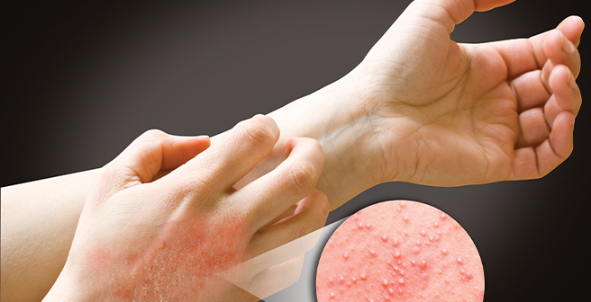 Image of arm with zoomed in graphic that shows skin irritation from latex allergy or chemical allergy