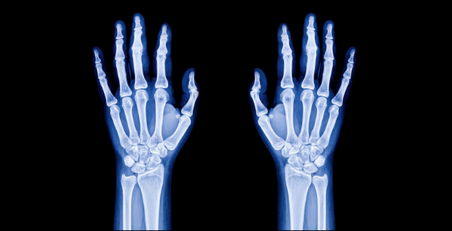 Рентген здоровой кисти левой руки фото Рентген рук Александр Филюрин. Ежедневные заметки