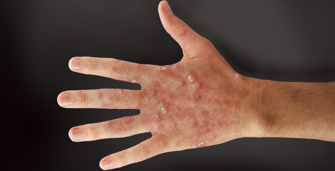 Hand Hygiene and Skin Care