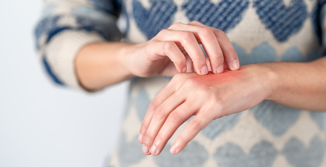 Young woman scratching her itchy hand Concept skin problem allergy and dermatology